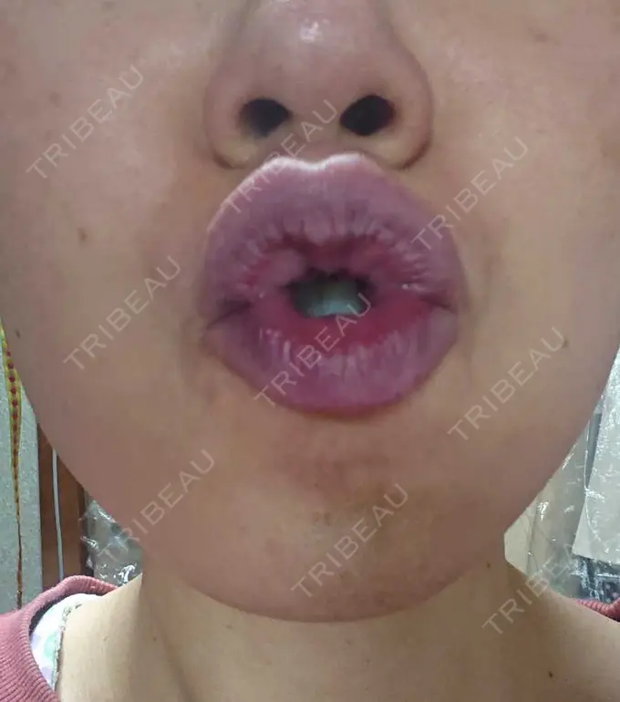 ボトックス（あご） / ボトックス（口角） MAクリニック 心斎橋 DAY 2 メイン用