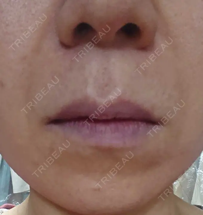 ボトックス（あご） / ボトックス（口角） MAクリニック 心斎橋 DAY 2 メイン用