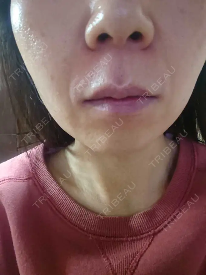 ボトックス（あご） / ボトックス（口角） MAクリニック 心斎橋 DAY 3 メイン用