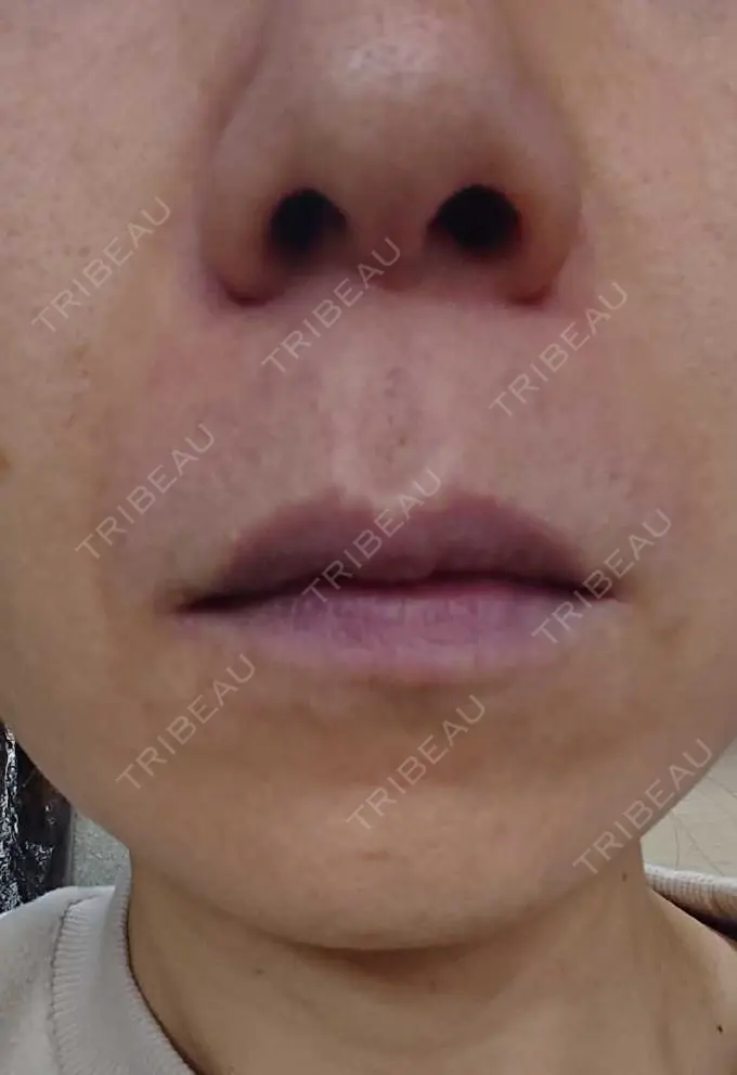 ボトックス（あご） / ボトックス（口角） MAクリニック 心斎橋 DAY 6 メイン用