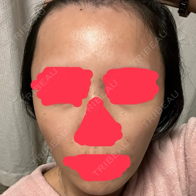 ピコフラクショナルレーザー（毛穴・ニキビ跡） ルラ美容クリニック 大阪本院 AFTER メイン用