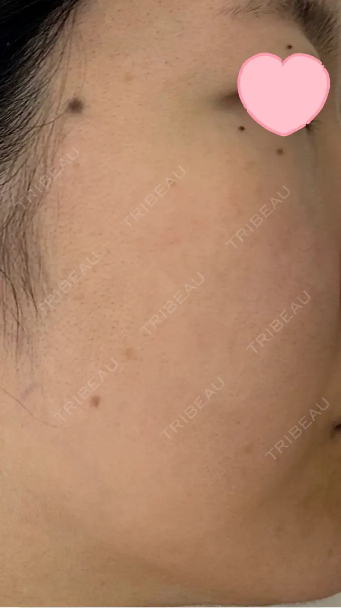 ルメッカ ルラ美容クリニック 高田馬場院 AFTER メイン用