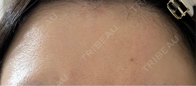 ルメッカ ルラ美容クリニック 高田馬場院 DAY 46 メイン用