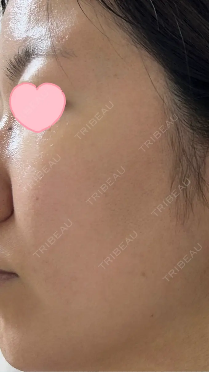 ルメッカ ルラ美容クリニック 高田馬場院 DAY 46 メイン用