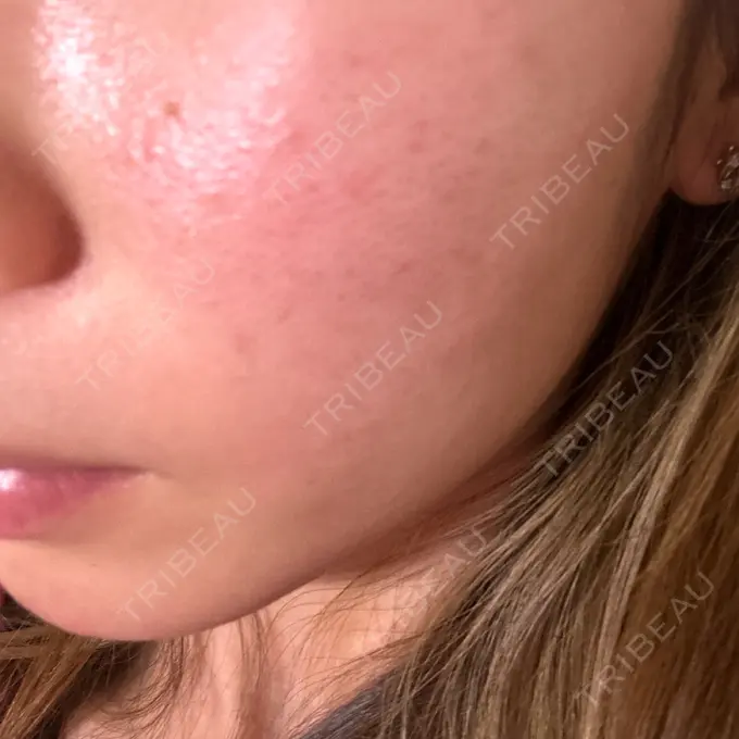 イオン導入 / ピコレーザートーニング（美白・肝斑） / フラクショナルレーザー（毛穴・ニキビ跡） ルラ美容クリニック 横浜院 AFTER メイン用