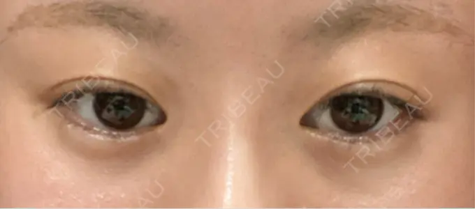 ボトックス（目尻） veary clinic DAY 7 メイン用