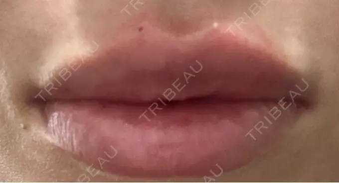 ヒアルロン酸注入（唇） Code Beauty Clinic 名古屋院 DAY 0 メイン用