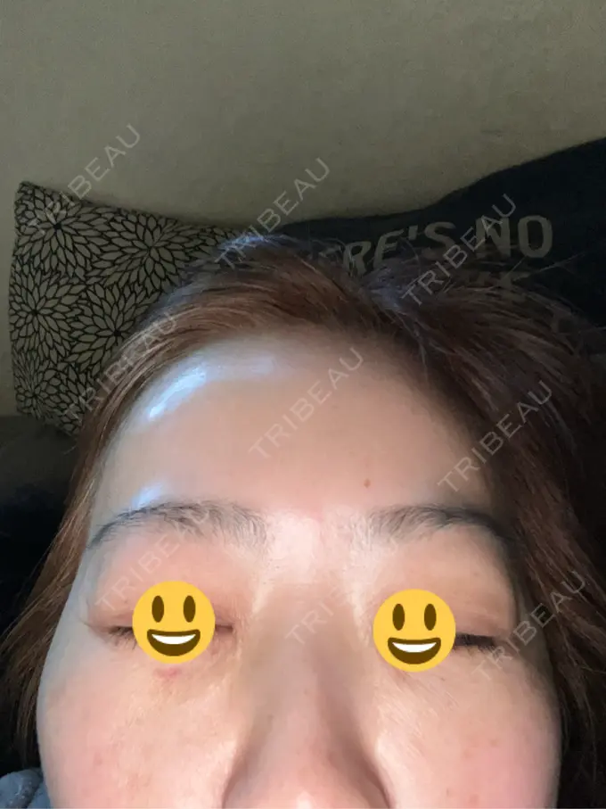 シワ取りボトックス / その他（肌） / スネコス ルラ美容クリニック 神戸院 AFTER メイン用