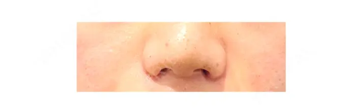 鼻尖形成（切開） / 鼻中隔延長（切開） / 小鼻縮小（切開） / 軟骨移植 R Beauty CLINIC 大阪院 AFTER メイン用