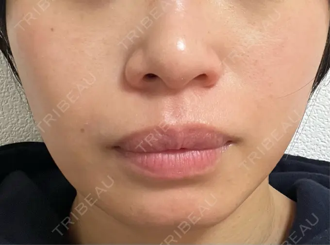 ボトックス（エラ・小顔） L‘amour clinic Tokyo【ラムールクリニック東京】 AFTER メイン用