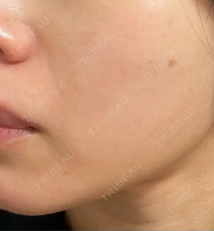 ボトックス（エラ・小顔） L‘amour clinic Tokyo【ラムールクリニック東京】 DAY 14 メイン用