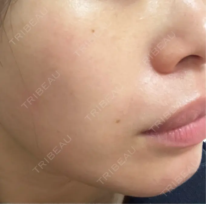 ボトックス（エラ・小顔） L‘amour clinic Tokyo【ラムールクリニック東京】 DAY 14 メイン用