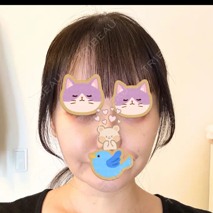 糸リフト / クマ治療 / 脂肪吸引（顔） / 脂肪注入（目の下） / ヒアルロン酸注入（涙袋） / ヒアルロン酸注入（唇） 東京シンデレラ美容外科 池袋院 DAY 62 メイン用