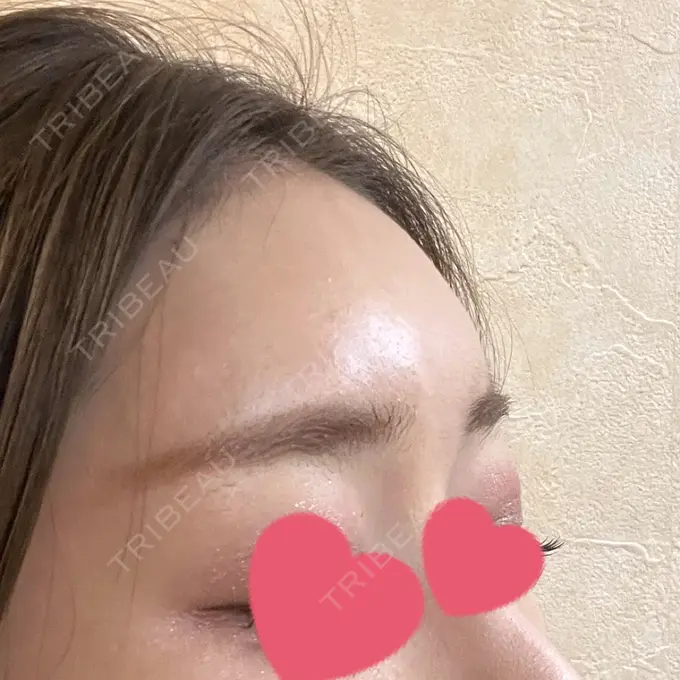 ヒアルロン酸注入（額） B-LINE CLINIC 大阪院 AFTER メイン用