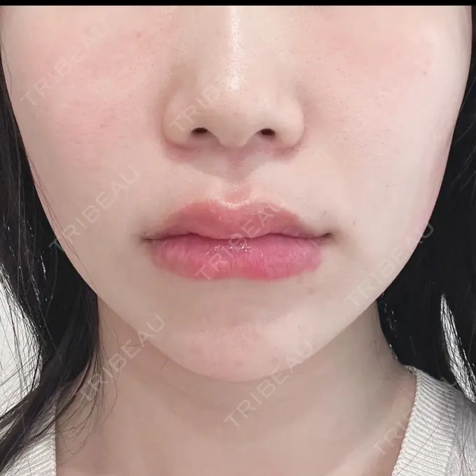 ハイフ（顔） ミニマムスキンクリニック池袋 AFTER メイン用