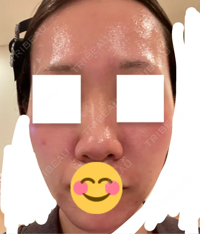 エレクトロポレーション / ヴェルヴェットスキン ミニマムスキンクリニック池袋 DAY 0 メイン用