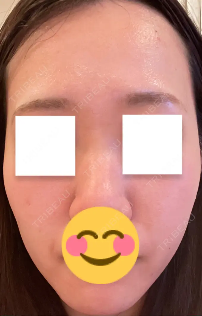 エレクトロポレーション / ヴェルヴェットスキン ミニマムスキンクリニック池袋 DAY 1 メイン用