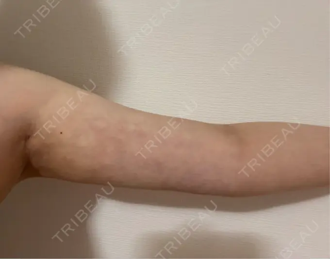 脂肪吸引（二の腕） Mods Clinic（モッズクリニック） 名古屋院 DAY 31 メイン用