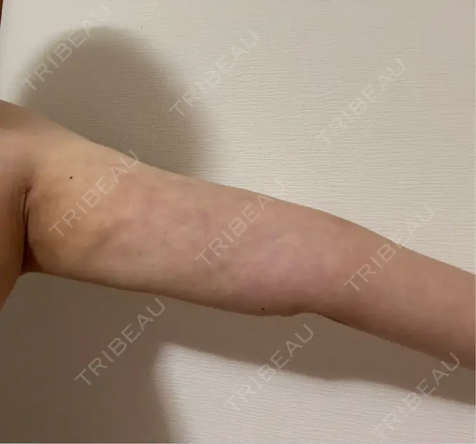 脂肪吸引（二の腕） Mods Clinic（モッズクリニック） 名古屋院 DAY 31 メイン用