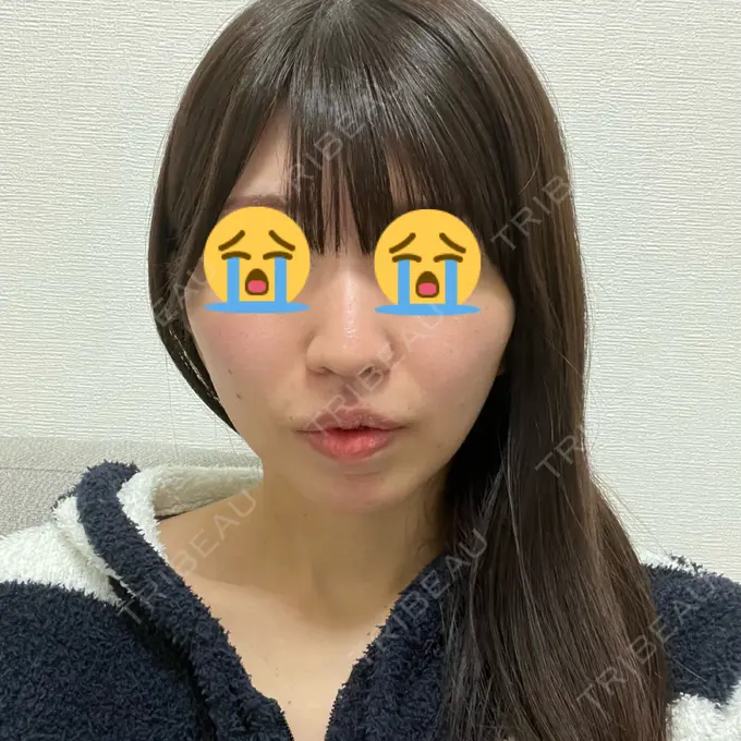 小鼻縮小（切開） / 人中短縮 / 鼻翼挙上 / ボトックス（ガミースマイル） Otus Clinic 【オータスクリニック】 DAY 34 メイン用