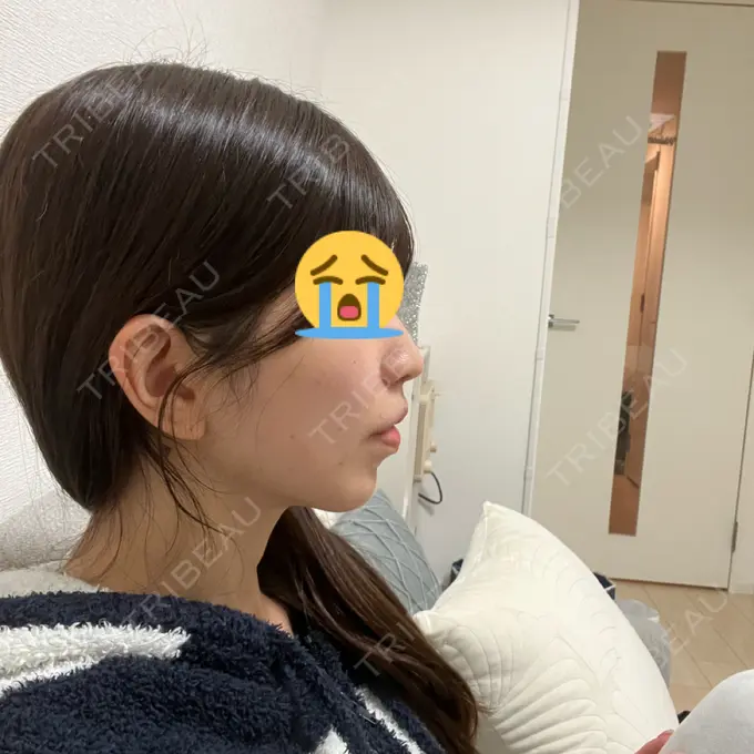 小鼻縮小（切開） / 人中短縮 / 鼻翼挙上 / ボトックス（ガミースマイル） Otus Clinic 【オータスクリニック】 DAY 34 メイン用