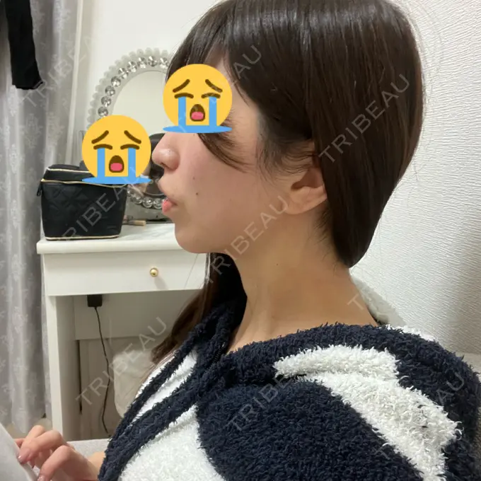 小鼻縮小（切開） / 人中短縮 / 鼻翼挙上 / ボトックス（ガミースマイル） Otus Clinic 【オータスクリニック】 DAY 34 メイン用