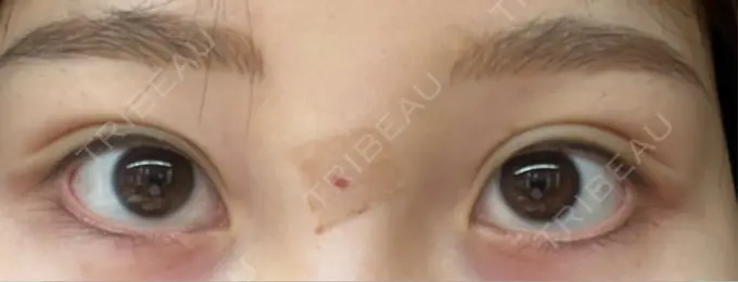 アートメイク（アイライン） Kinshicho Beauty Clinic （錦糸町ビューティークリニック） DAY 3 メイン用