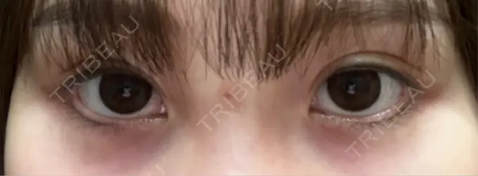 アートメイク（アイライン） Kinshicho Beauty Clinic （錦糸町ビューティークリニック） DAY 5 メイン用