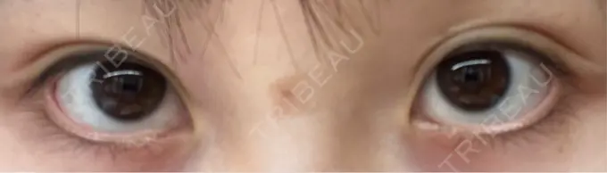 アートメイク（アイライン） Kinshicho Beauty Clinic （錦糸町ビューティークリニック） DAY 6 メイン用