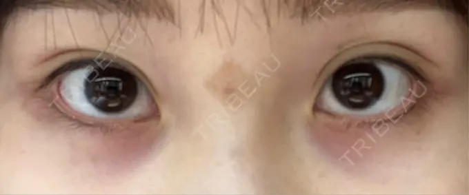 アートメイク（アイライン） Kinshicho Beauty Clinic （錦糸町ビューティークリニック） DAY 7 メイン用