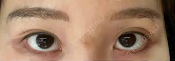 アートメイク（アイライン） Kinshicho Beauty Clinic （錦糸町ビューティークリニック） DAY 8 メイン用