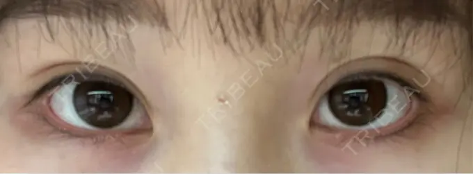 アートメイク（アイライン） Kinshicho Beauty Clinic （錦糸町ビューティークリニック） DAY 9 メイン用