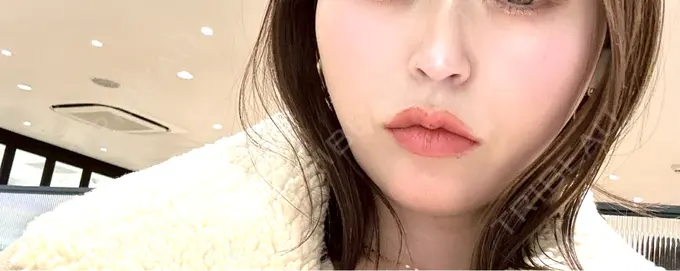 ピーリング（ハリ・ツヤ） ルラ美容クリニック 名古屋栄院 / ルラスキンクリニック 名古屋栄院 AFTER メイン用