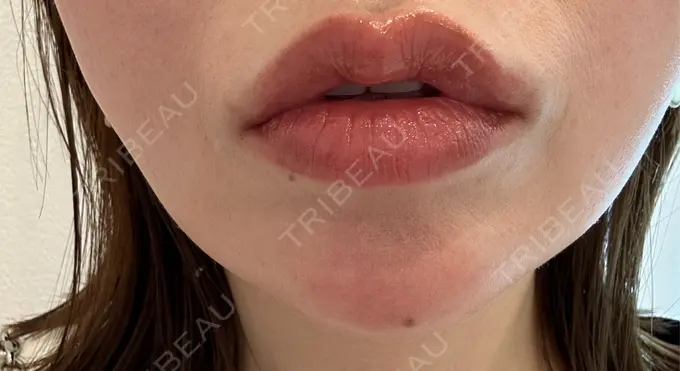 ヒアルロン酸注入（あご） / ルメッカ Code Beauty Clinic 名古屋院 DAY 1 メイン用