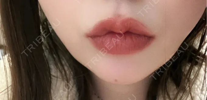 ヒアルロン酸注入（あご） / ルメッカ Code Beauty Clinic 名古屋院 AFTER メイン用