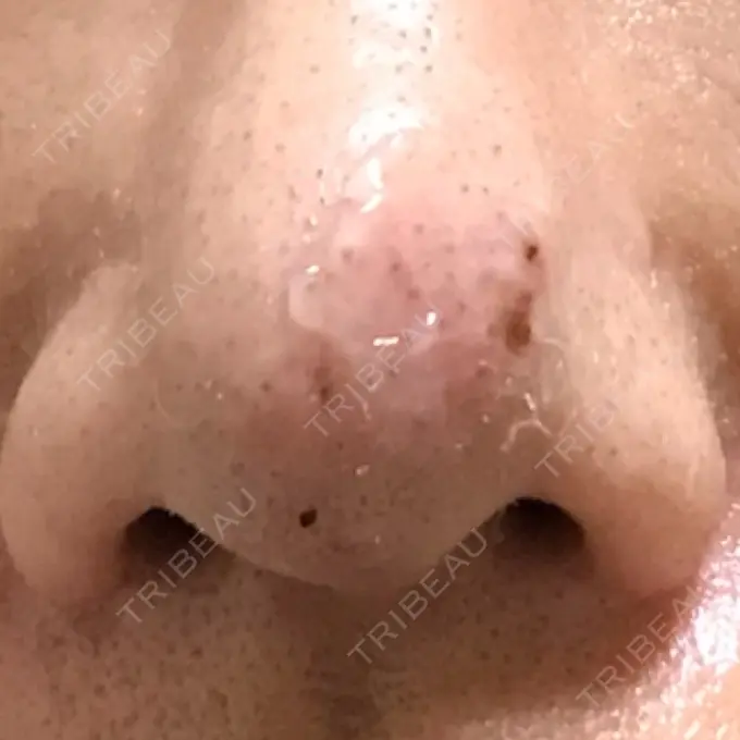 鼻尖形成（切開） 水の森美容クリニック 名古屋院 DAY 8 メイン用