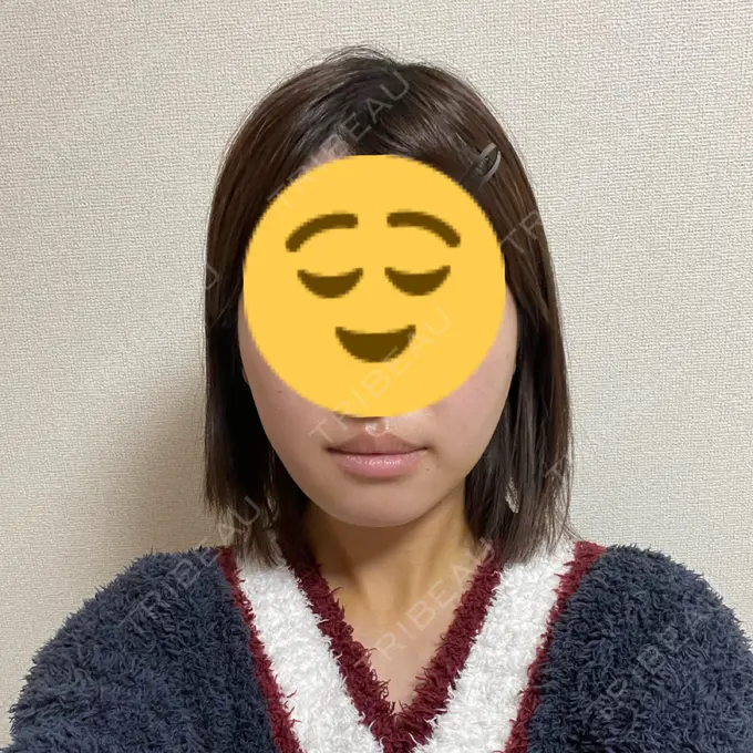 糸リフト / バッカルファット除去 / 脂肪吸引（顔） / ボトックス（エラ・小顔） アリエル美容クリニック 大宮院 DAY 7 メイン用