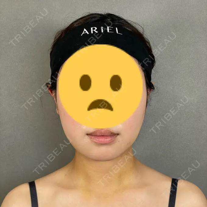 糸リフト / バッカルファット除去 / 脂肪吸引（顔） / ボトックス（エラ・小顔） アリエル美容クリニック 大宮院 DAY 8 メイン用