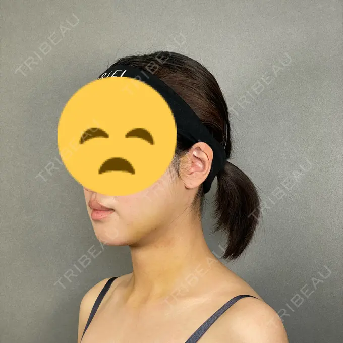 糸リフト / バッカルファット除去 / 脂肪吸引（顔） / ボトックス（エラ・小顔） アリエル美容クリニック 大宮院 DAY 8 メイン用