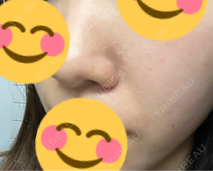 エレクトロポレーション / ヴェルヴェットスキン ミニマムスキンクリニック池袋 DAY 2 メイン用