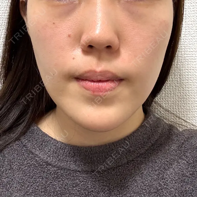 糸リフト / ヒアルロン酸注入（あご） L‘amour clinic Tokyo【ラムールクリニック東京】 AFTER メイン用