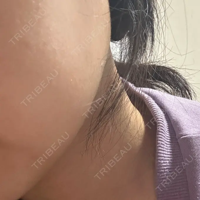 ボトックス（あご） / ボトックス（エラ・小顔） / 脂肪溶解注射（顔） / その他（鼻） Zetith Beauty Clinic 福岡院 DAY 0 メイン用