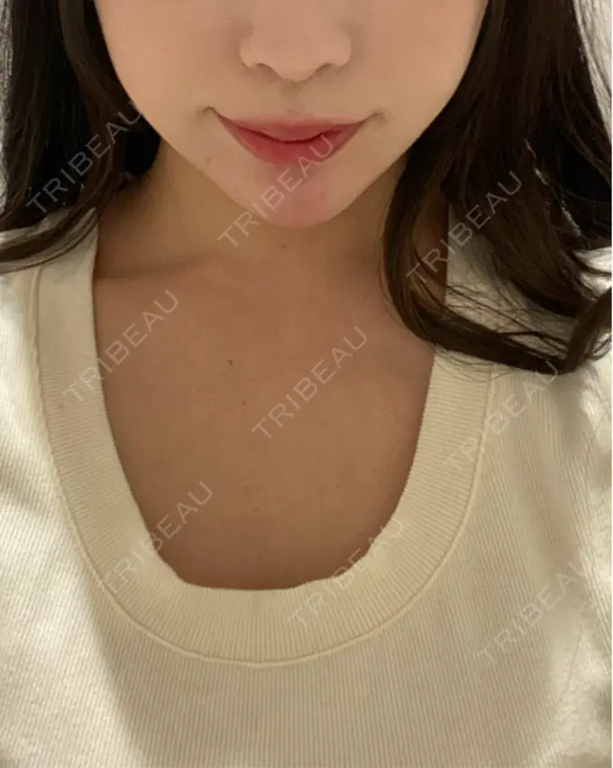 ヒアルロン酸注入（あご） ファイヤークリニック 名古屋院 DAY 0 メイン用