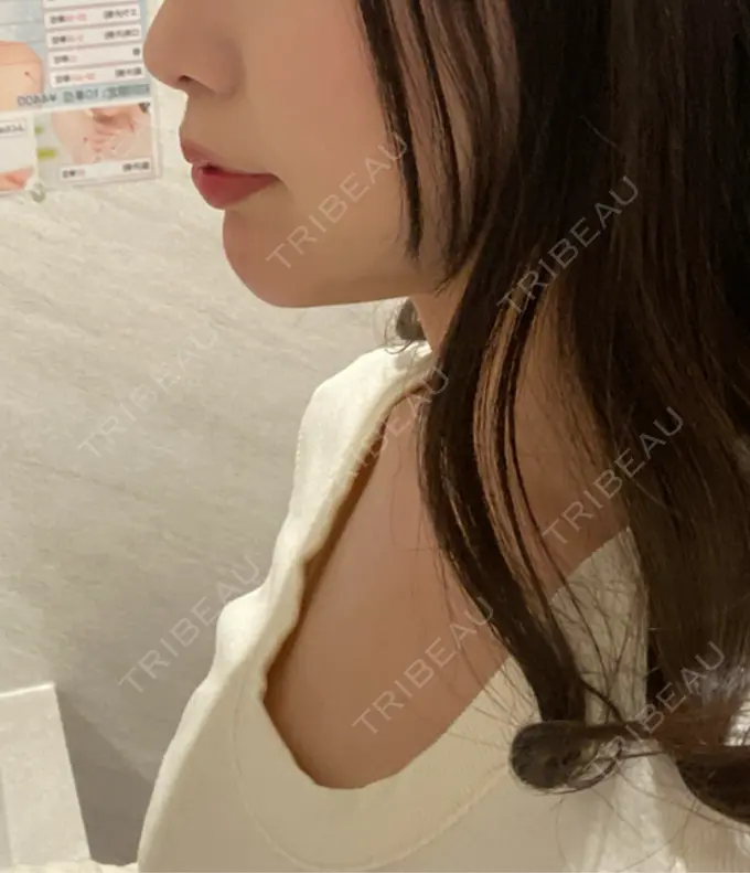 ヒアルロン酸注入（あご） ファイヤークリニック 名古屋院 DAY 0 メイン用