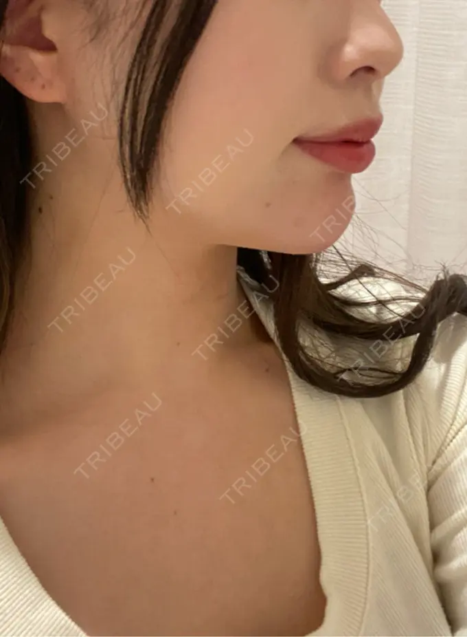 ヒアルロン酸注入（あご） ファイヤークリニック 名古屋院 DAY 0 メイン用