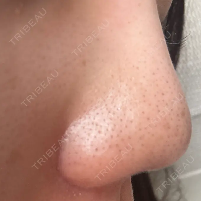 小鼻縮小（切開） / 鼻翼挙上 / その他（鼻） 東京形成美容外科 銀座院 DAY 53 メイン用