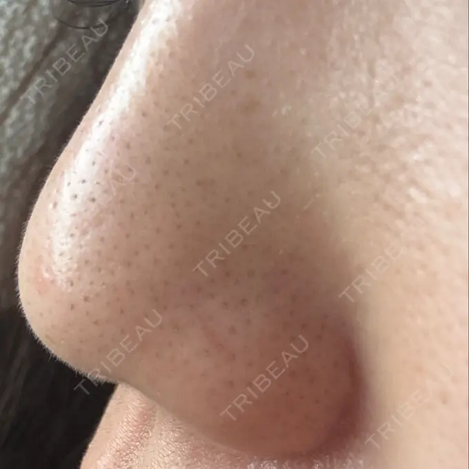 小鼻縮小（切開） / 鼻翼挙上 / その他（鼻） 東京形成美容外科 銀座院 DAY 53 メイン用