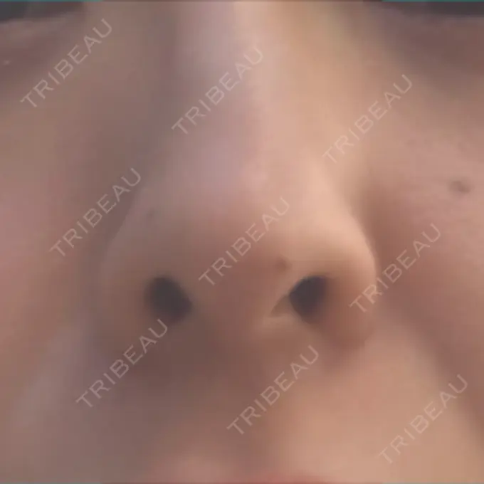 ピーリング（ニキビ・毛穴） / 美肌レーザー / シミ取りレーザー / 美白レーザー / 毛穴洗浄（ハイドラフェイシャルなど） / ピコレーザートーニング（美白・肝斑） / レーザートーニング（美白・肝斑） / レーザーフェイシャル / ピーリング（ハリ・ツヤ） LE CLINIC AFTER メイン用