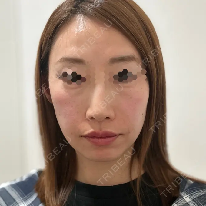 ヒアルロン酸注入（涙袋） / ヒアルロン酸注入（唇） / ヒアルロン酸注入（鼻翼基部） THE FIRST CLINIC 町田院 AFTER メイン用