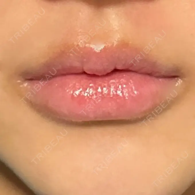 ヒアルロン酸注入（唇） / ボトックス（口角） ルラ美容クリニック 高田馬場院 DAY 19 メイン用